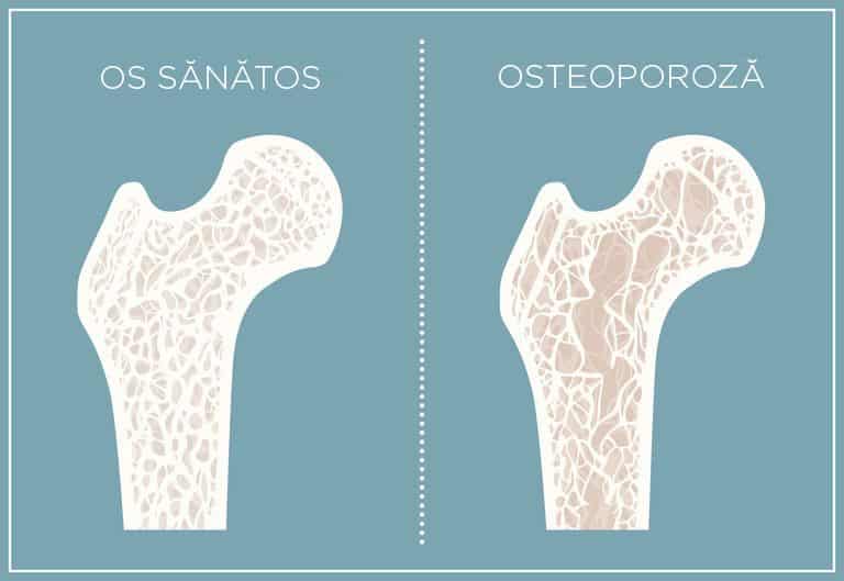ossiforte-osteoporoza